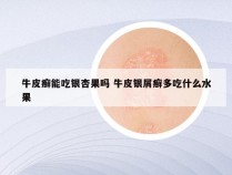 牛皮癣能吃银杏果吗 牛皮银屑癣多吃什么水果