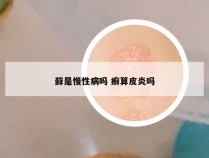 藓是慢性病吗 癣算皮炎吗