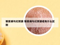 银屑病与红斑狼 银屑病与红斑狼疮有什么区别