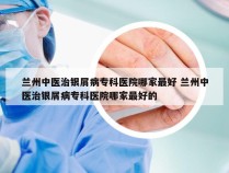 兰州中医治银屑病专科医院哪家最好 兰州中医治银屑病专科医院哪家最好的