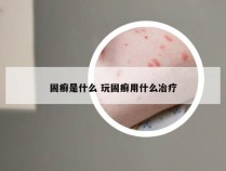 固癣是什么 玩固癣用什么冶疗