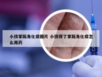 小孩掌跖角化症图片 小孩得了掌跖角化症怎么用药