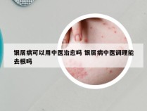 银屑病可以用中医治愈吗 银屑病中医调理能去根吗