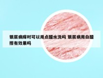 银屑病痒时可以用点醋水洗吗 银屑病用白醋擦有效果吗