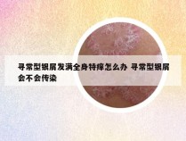 寻常型银屑发满全身特痒怎么办 寻常型银屑会不会传染