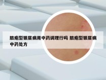 脓疱型银屑病用中药调理行吗 脓疱型银屑病中药处方