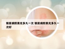 银屑病照黑光多久一次 银屑病照黑光多久一次好