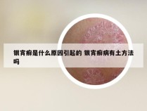 银宵癣是什么原因引起的 银宵癣病有土方法吗