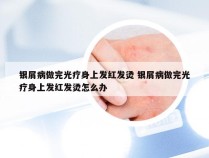 银屑病做完光疗身上发红发烫 银屑病做完光疗身上发红发烫怎么办