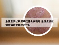 急性点滴状银屑病吃什么食物好 急性点滴状银屑病需要住院治疗吗