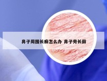 鼻子周围长癣怎么办 鼻子旁长藓