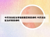 中药泡浴能治掌指脓胞型银屑病吗 中药泡浴能治好银屑病吗