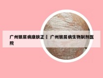 广州银屑病康肤正規 广州银屑病生物制剂医院