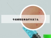 牛皮癣现在有治疗方法了么