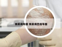 银屑病导图 银屑病思维导图