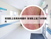 宝宝脸上出现白斑图片 宝宝脸上起了白斑图片