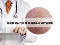 银屑病可以吃泥鳅 银屑病人可以吃泥鳅吗