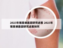 2023年银屑病基因研究进展 2023年银屑病基因研究进展如何