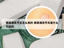 银屑病关节炎怎么来的 银屑病关节炎是什么引起的