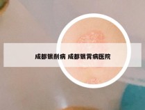 成都银削病 成都银霄病医院