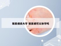 银屑病读大学 银屑病可以休学吗