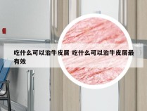 吃什么可以治牛皮屑 吃什么可以治牛皮屑最有效