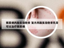 银屑病丙酸氯倍他索 复方丙酸氯倍他索乳膏可以治疗银屑病