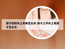 孩子住校头上长癣怎么办 孩子上学头上有虱子怎么办