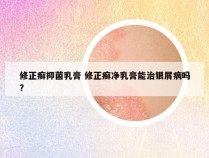 修正癣抑菌乳膏 修正癣净乳膏能治银屑病吗?