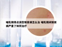 哺乳期得点滴型银屑病怎么治 哺乳期间银屑病严重了如何治疗