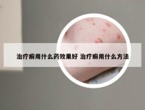 治疗癣用什么药效果好 治疗癣用什么方法