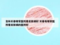 吉林长春哪家医院看皮肤病好 长春有哪家医院看皮肤病的医院好