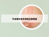 牛皮癣长在外阴和大腿根部