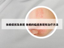 体癣症状及表现 体癣的临床表现和治疗方法