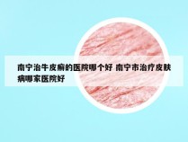 南宁治牛皮癣的医院哪个好 南宁市治疗皮肤病哪家医院好