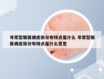 寻常型银屑病皮损分布特点是什么 寻常型银屑病皮损分布特点是什么意思