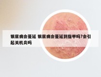 银屑病会蔓延 银屑病会蔓延到指甲吗?会引起关机炎吗