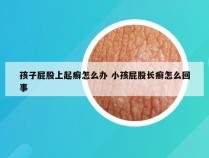 孩子屁股上起癣怎么办 小孩屁股长癣怎么回事