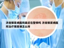 济南银屑病医院最近在整顿吗 济南银屑病医院治疗银屑病怎么样