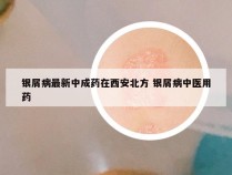 银屑病最新中成药在西安北方 银屑病中医用药