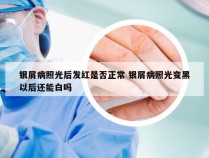 银屑病照光后发红是否正常 银屑病照光变黑以后还能白吗