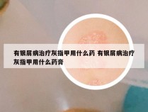 有银屑病治疗灰指甲用什么药 有银屑病治疗灰指甲用什么药膏