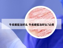 牛皮廨能治好么 牛皮廨能治好么?止痒