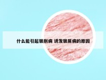 什么能引起银削病 诱发银屑病的原因