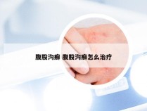 腹股沟癣 腹股沟癣怎么治疗