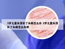 3岁儿童头顶长了头癣怎么办 3岁儿童头顶长了头癣怎么办呢