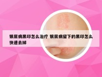 银屑病黑印怎么治疗 银屑病留下的黑印怎么快速去掉