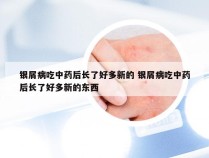 银屑病吃中药后长了好多新的 银屑病吃中药后长了好多新的东西