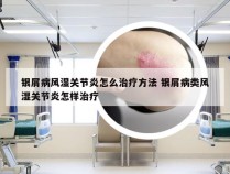 银屑病风湿关节炎怎么治疗方法 银屑病类风湿关节炎怎样治疗