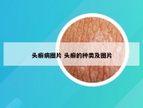 头癣病图片 头癣的种类及图片